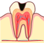 虫歯の中期