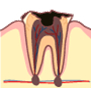 虫歯の末期